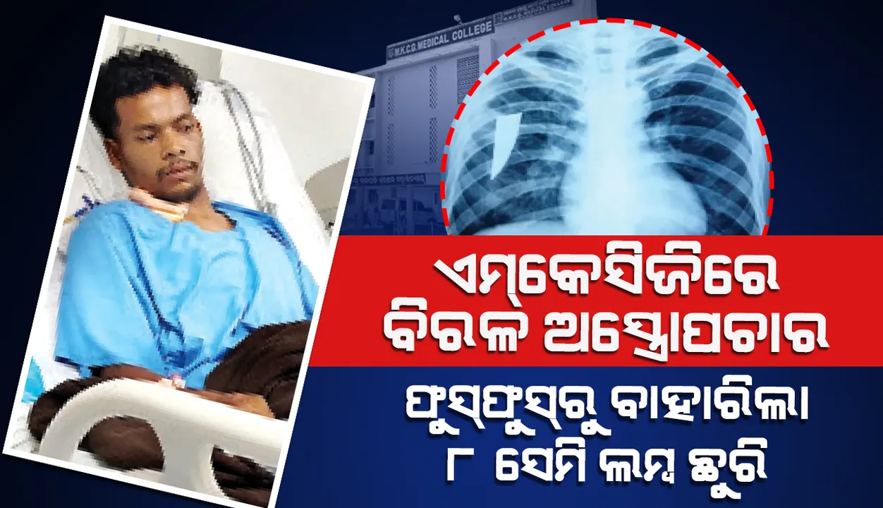  ଏମ୍‌କେସିଜିରେ ବିରଳ ଅସ୍ତ୍ରୋପଚାର  ଫୁସ୍‌ଫୁସ୍‌ରୁ ବାହାରିଲା ୮ ସେମି ଲମ୍ବ ଛୁରି