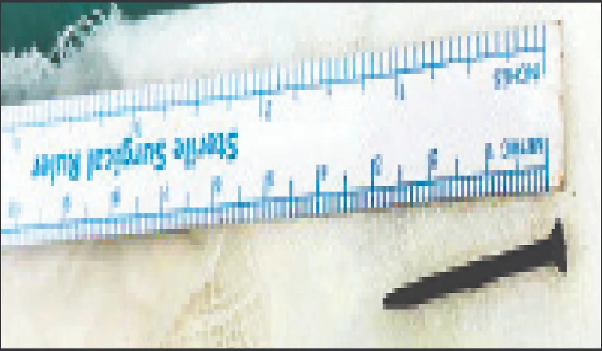  ଶିଶୁଭବନର ବିରଳ ସଫଳତା: ବିନା ଅସ୍ତ୍ରୋପଚାରରେ ବାହାରିଲା ଦେଢ଼ ଇଞ୍ଚର କଣ୍ଟା