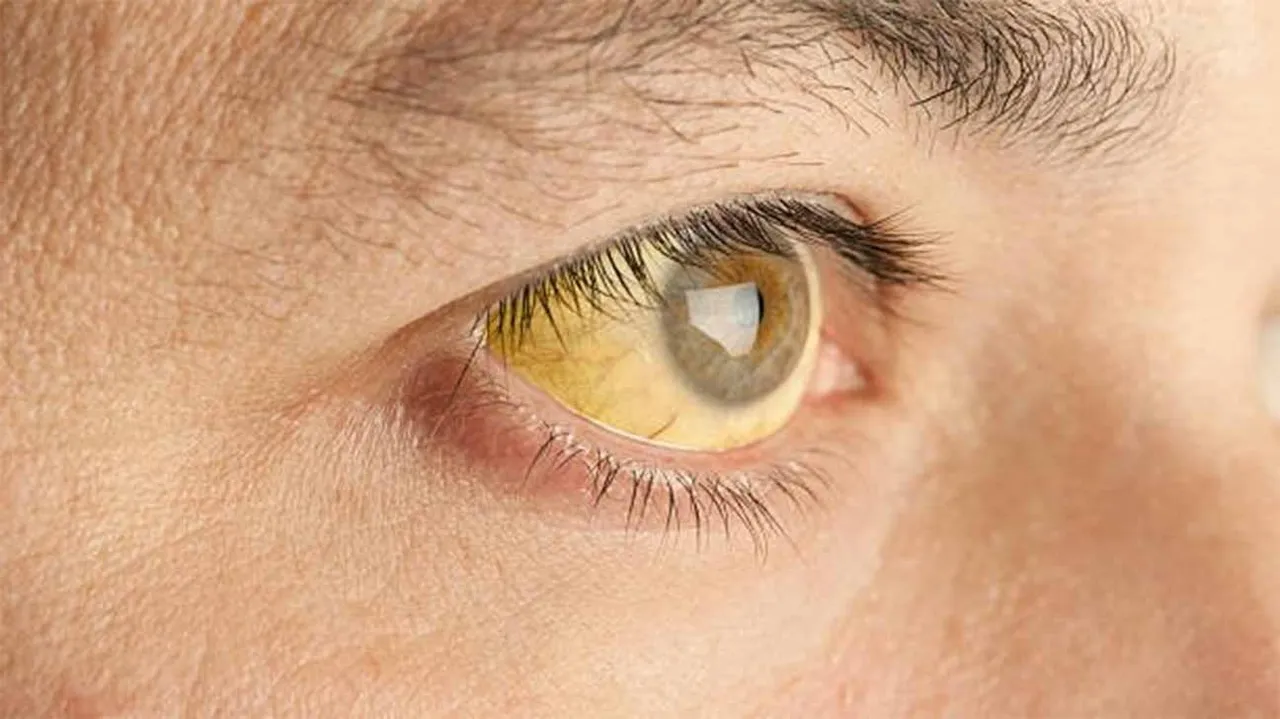  Photograph: (https://www.cdc.gov/yellow-fever/symptoms-diagnosis-treatment/index.html) 