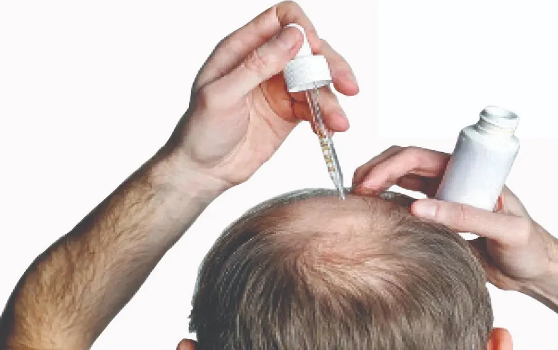  hair loss will be gone: କୋଡ଼ିଏ ଦିନରେ ଦୂର ହେବ ଚନ୍ଦାପଣ!