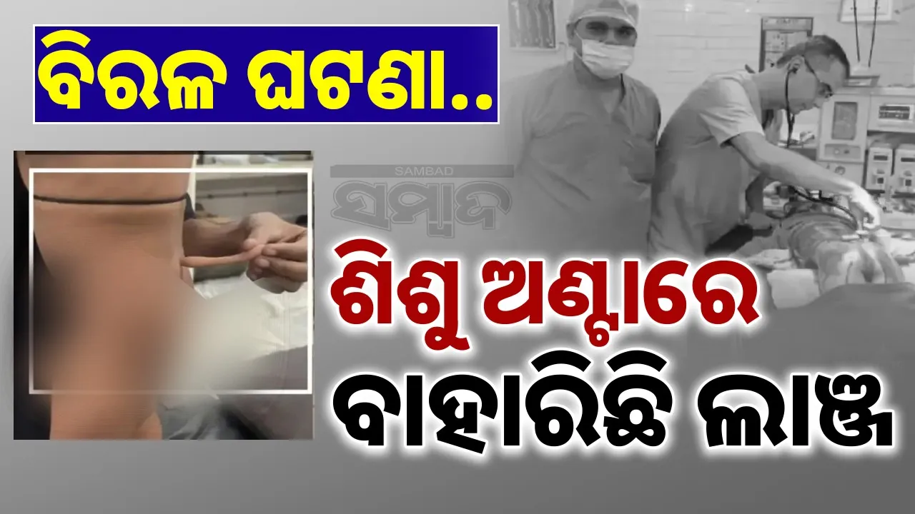  doctors remove tail from ୂtoddler Photograph: (@sambad.in) 