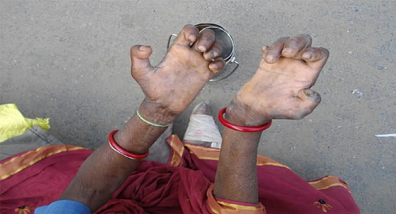  leprosy free odisha: କୁଷ୍ଠମୁକ୍ତ ଓଡ଼ିଶା ଏବେ କୁଷ୍ଠପ୍ରବଣ: ୭ବର୍ଷରେ ୫୫ହଜାରରୁ ଅଧିକ କୁଷ୍ଠ ରୋଗୀ ଚିହ୍ନଟ