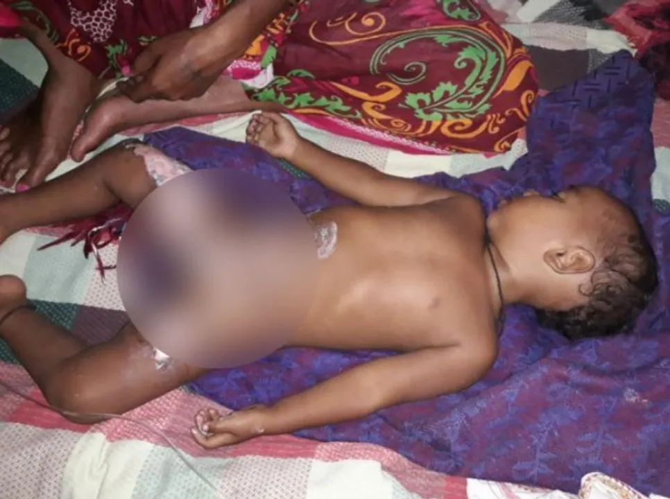  ନିଆଁରେ ପୋଡି ହୋଇ ୨ ବର୍ଷର ଶିଶୁ ଗୁରୁତର
