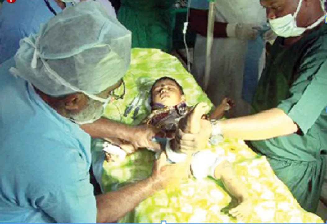  ୨୫ ଶିଶୁଙ୍କ ବକ୍ରପାଦ ଅସ୍ତ୍ରୋପଚାର