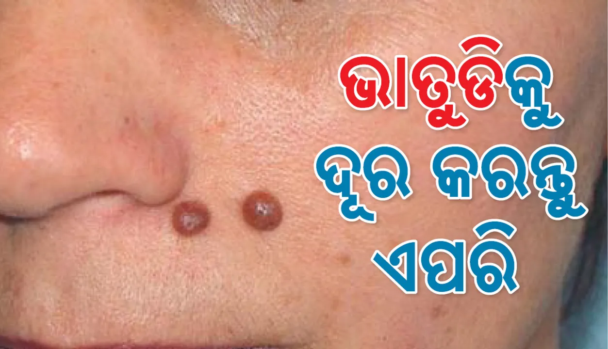  ରାତିକ ଭିତରେ ଆପଣଙ୍କ ମୁହଁରୁ ଉଭେଇଯିବ ଭାତୁଡ଼ି , ବାସ୍‌ ଆପଣାନ୍ତୁ ଏହି ସହଜ ଉପାୟ