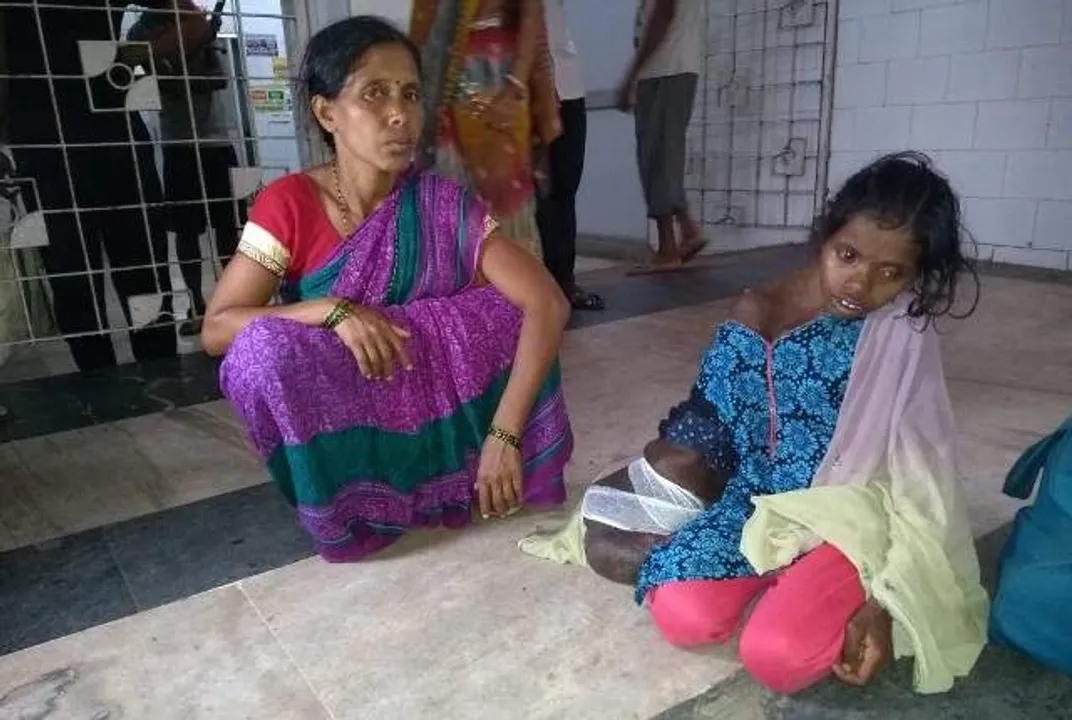 ଅସ୍ୱାଭାବିକ ଭାବେ ବଢ଼ୁଛି ହାତ, ଅସ୍ତ୍ରୋପଚାର ପାଇଁ ଏସ୍‌ସିବିରେ ଭର୍ତ୍ତି