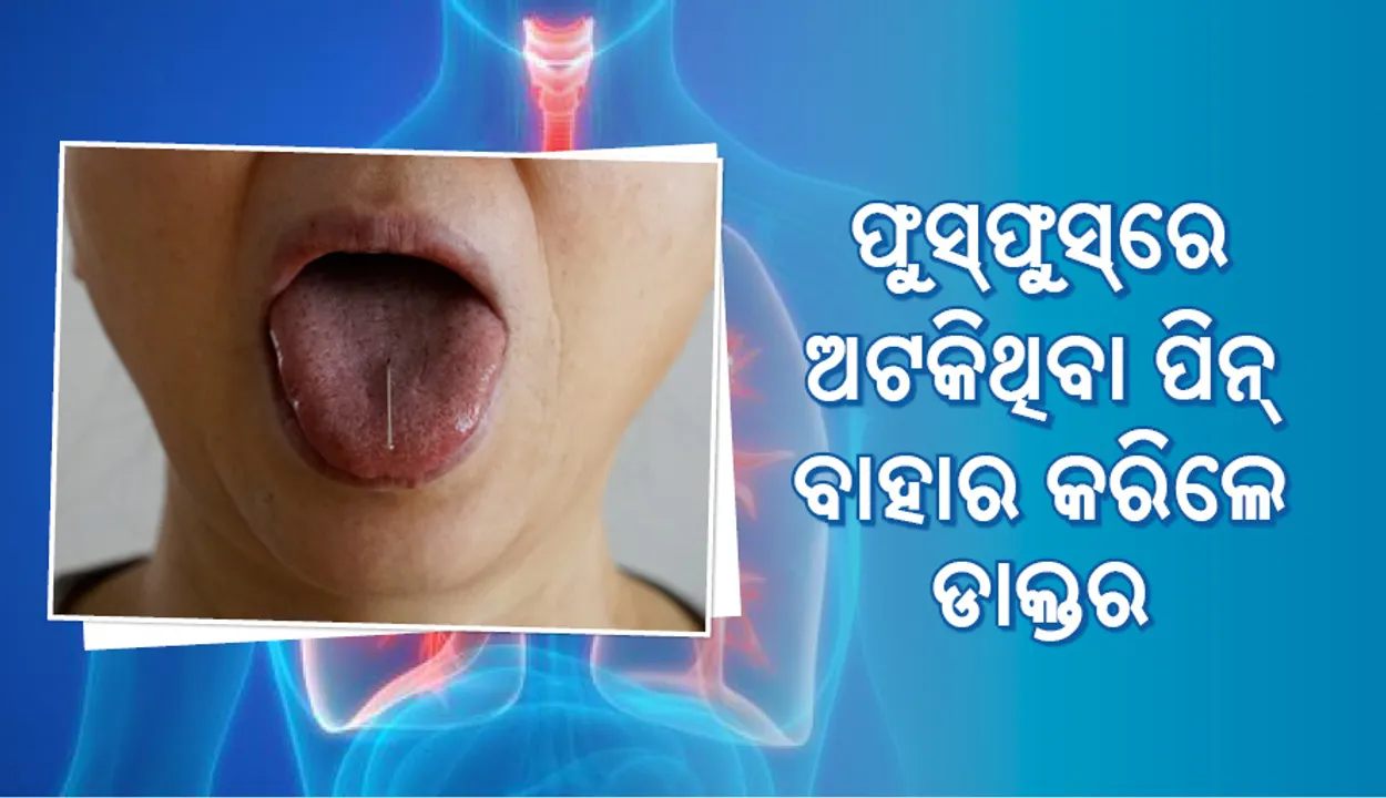  ଯୁବତୀଙ୍କ ଫୁସଫୁସରେ ଅଟକିଥିବା ପିନ୍‌ କାଢ଼ିଲେ ଡାକ୍ତର