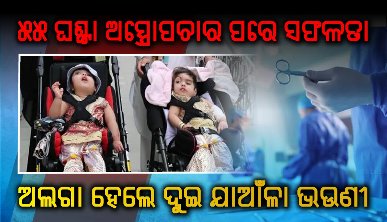  ୫୫ ଘଣ୍ଟାର ଅସ୍ତ୍ରୋପଚାର ପରେ ସଫଳତାର ସହ ଅଲଗା ହେଲେ ଦୁଇ ଯାଆଁଳା  ଭଉଣୀ