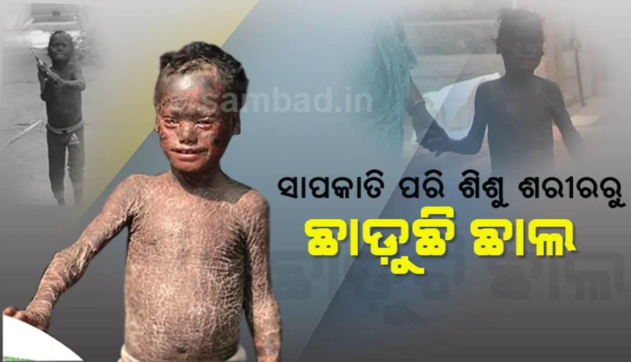  ଅଭିଶପ୍ତ ଜୀବନ: ସାପ ଭଳି ଶିଶୁ ଶରୀରରୁ ବାହାରୁଛି ଛାଲି, ଶୋଇବା ସମୟରେ ବି ବନ୍ଦ ହେଉ ନାହିଁ ଆଖିପତା