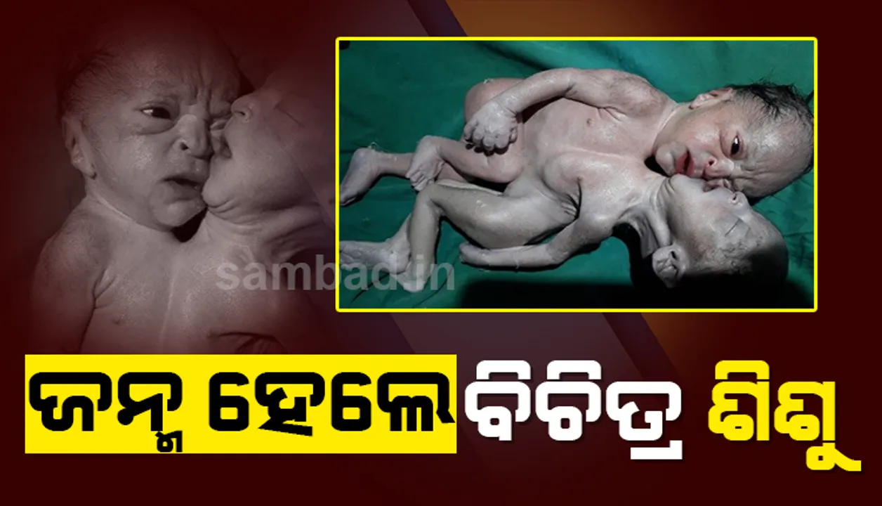  ଜନ୍ମ ନେଲା ଚାରିଟି ଗୋଡ଼, ଚାରିଟି ହାତ ଓ ଦୁଇଟି ମୁଣ୍ଡ ଥିବା ବିଚିତ୍ର ଶିଶୁ