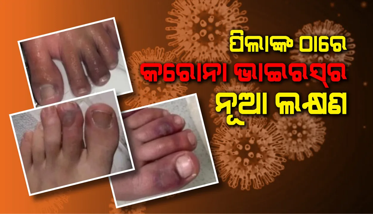  ପିଲାଙ୍କ ଠାରେ କରୋନାଭାଇରସ୍‌ ସଂକ୍ରମଣର ନୂଆ ଲକ୍ଷଣ: ‘କୋଭିଡ୍ ଟୋଜ୍‌’