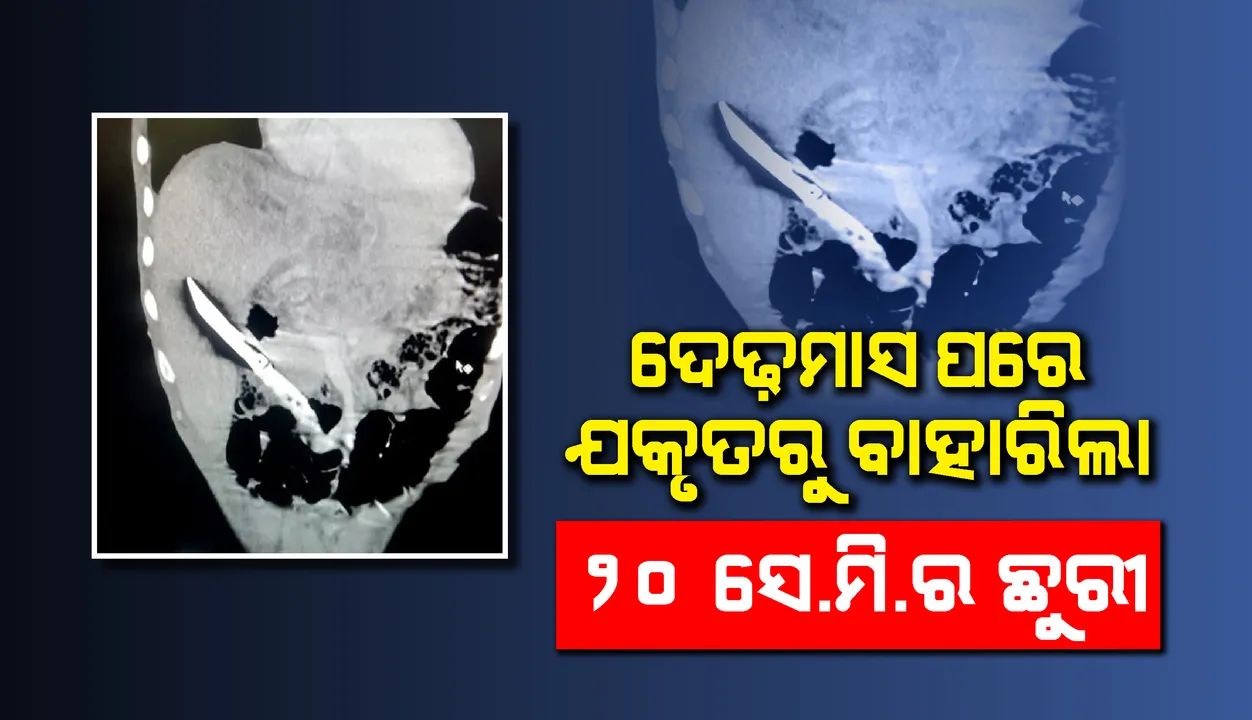 ଦେଢ଼ ମାସ ଧରି ଯୁବକଙ୍କ ଯକୃତରେ ଫସି ରହିଥିବା ୨୦ସେଣ୍ଟିମିଟରର ଛୁରୀକୁ ବାହାର କଲେ ଦିଲ୍ଲୀ ଏମ୍ସର ଡାକ୍ତରୀ ଟିମ୍