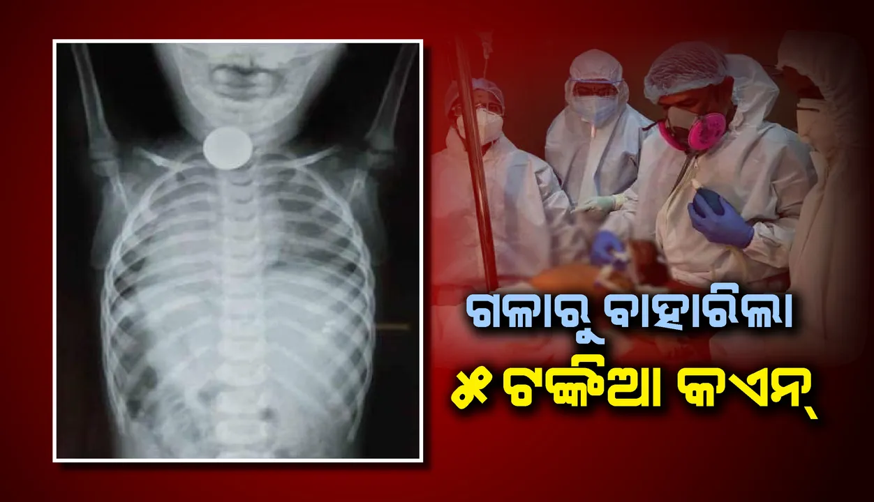  ୫ଟଙ୍କିଆ କଏନ ଗିଳିଦେଲା ବର୍ଷକର ଝିଅ, ଏହି କାରଣରୁ ବାହାର କରିବା ପାଇଁ ୪ଘଣ୍ଟା ଅପେକ୍ଷା କଲେ ଡାକ୍ତର