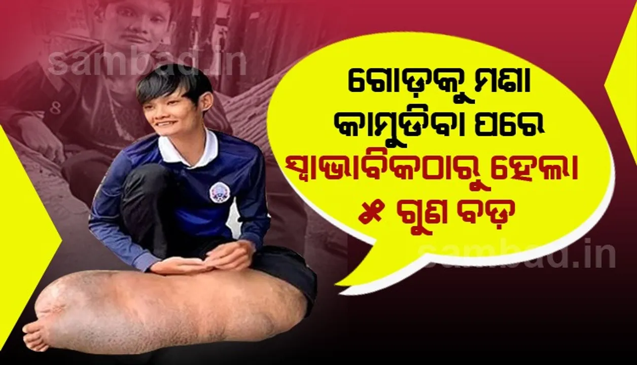  ମଶା କାମୁଡ଼ିବା ପରେ ଯୁବକଙ୍କ ଗୋଡ଼ର ଆକାର ୫ଗୁଣ ବଡ଼ ହୋଇଗଲା; ଚିକିତ୍ସା ହୋଇ ପାରିବ ନାହିଁ ବୋଲି ମନା କରି ଦେଲେ ଡାକ୍ତର