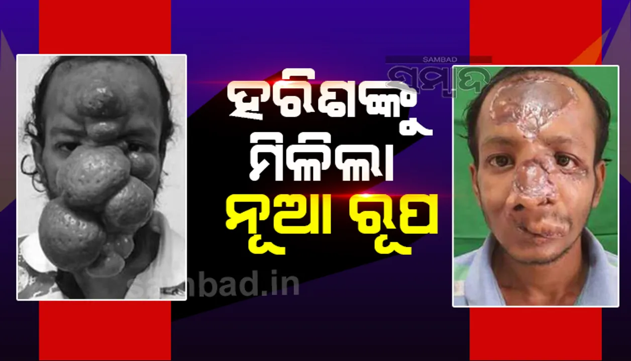  ପ୍ଲାଷ୍ଟିକ୍‌ ସର୍ଜରି ବିଭାଗରେ ବିରଳ ଅସ୍ତ୍ରୋପଚାର; ବାଲେଶ୍ବରର ହରିଶ ପାଇଲେ ନୂଆ ମୁହଁ