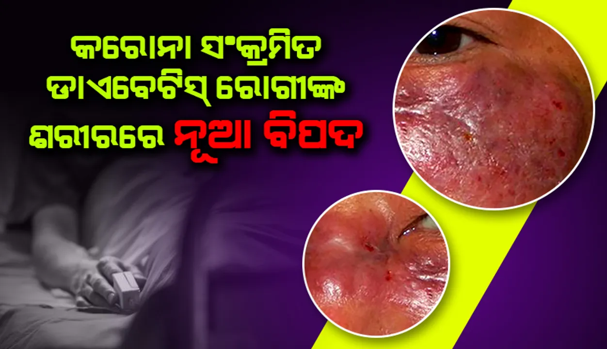  କରୋନା ସଂକ୍ରମିତ ଡାଏବେଟିସ ରୋଗୀଙ୍କ ଶରୀରରେ ଦେଖାଯାଉଛି ଏହି ନୂଆ ବିପଦ, ନାକ-କାନ ଓ ଗଳାରେ ହେଉଛି ସଂକ୍ରମଣ