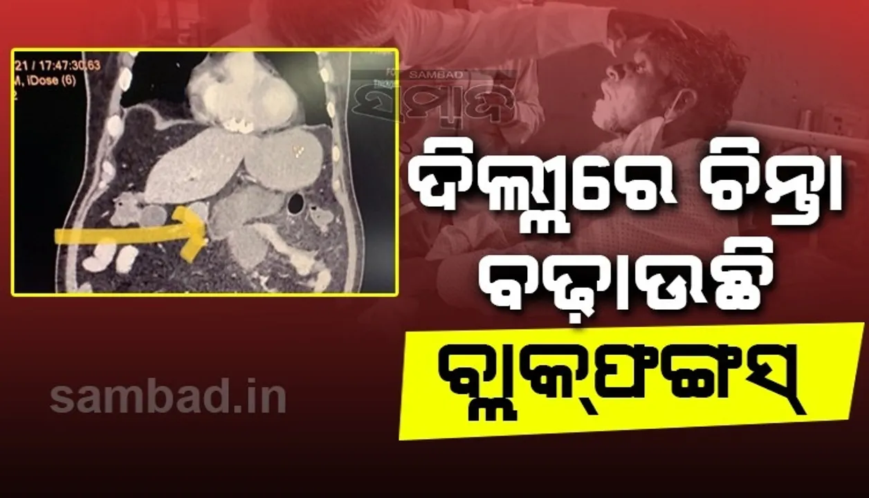  ବ୍ଲାକଫଙ୍ଗସ ବଢ଼ାଇଲା ଡାକ୍ତରଙ୍କ ଚିନ୍ତା, ଦିଲ୍ଲୀର ଗଙ୍ଗାରାମ ହସ୍ପିଟାଲରେ ମିଳିଲା ଦୁଇଟି ବିରଳ କେସ