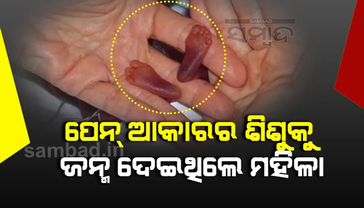  ପେନ ଆକାରର ଶିଶୁକୁ ଜନ୍ମ ଦେଇଥିଲେ ମହିଳା ! ଓଜନ ଥିଲା ୬୫୦ଗ୍ରାମ