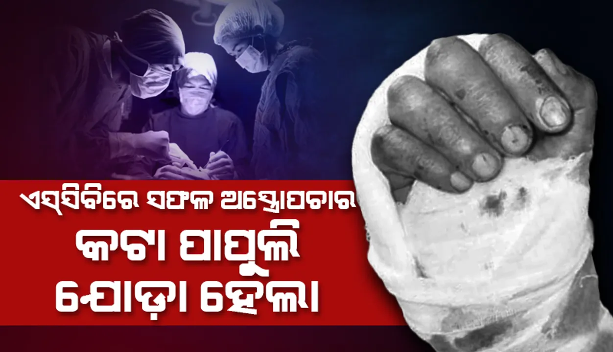  କଟା ପାପୁଲି ଯୋଡ଼ା ହେଲା, ମଧ୍ୟରାତିରେ ଏସ୍‌ସିବିରେ ହେଲା ସଫଳ ଅସ୍ତ୍ରୋପଚାର