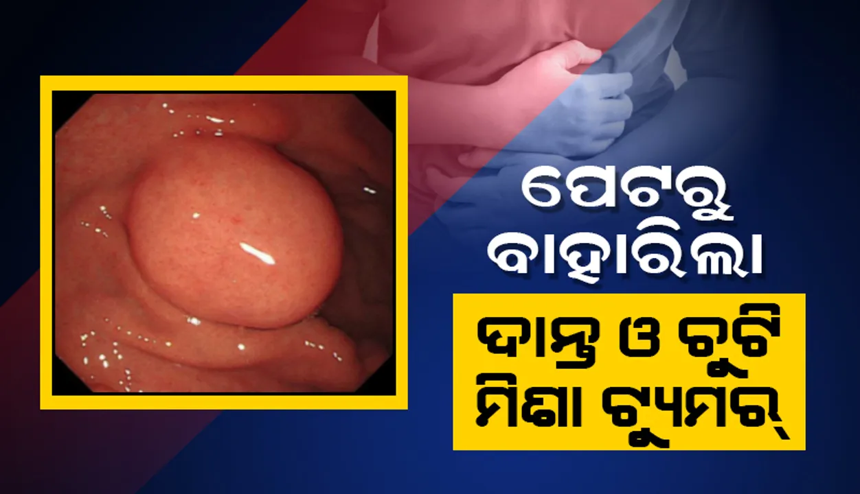 ପେଟରୁ ବାହାରିଲା ଦାନ୍ତ ଓ ଚୁଟି ମିଶା ଟ୍ୟୁମର