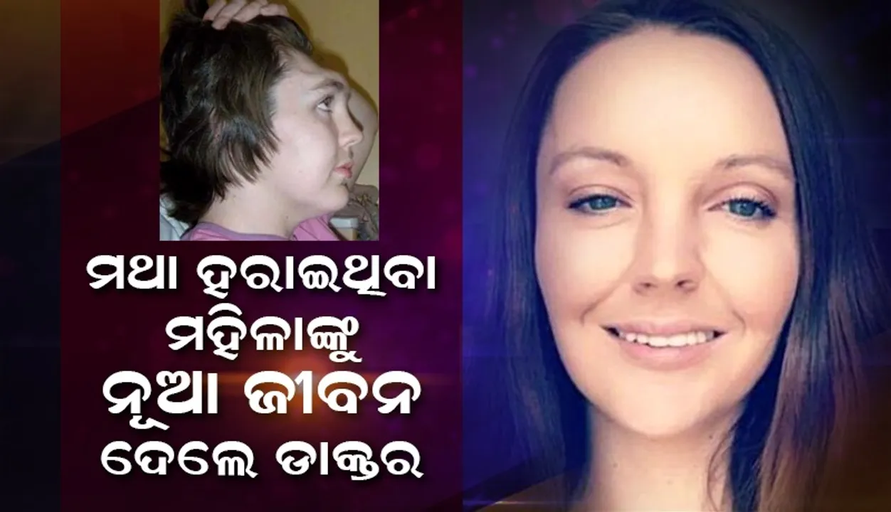  କାର ଦୁର୍ଘଟଣାରେ ମଥା ହରାଇଥିବା ମହିଳାଙ୍କୁ ନୂଆ ଜୀବନ ଦେଲେ ଡାକ୍ତର
