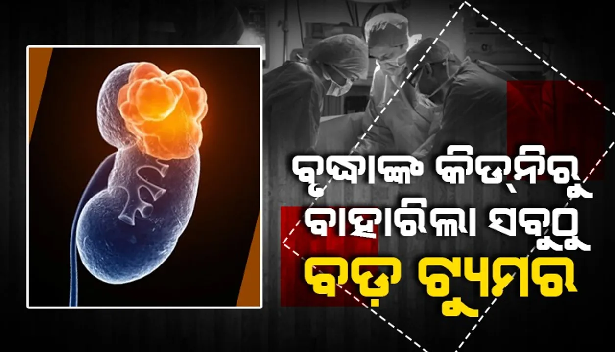  ଏଚଆଇଭି ପଜିଟିଭ ଥିବା ବୃଦ୍ଧାଙ୍କ କିଡନିରୁ ବାହାରିଲା ସବୁଠାରୁ ବଡ଼ ଟ୍ୟୁମର