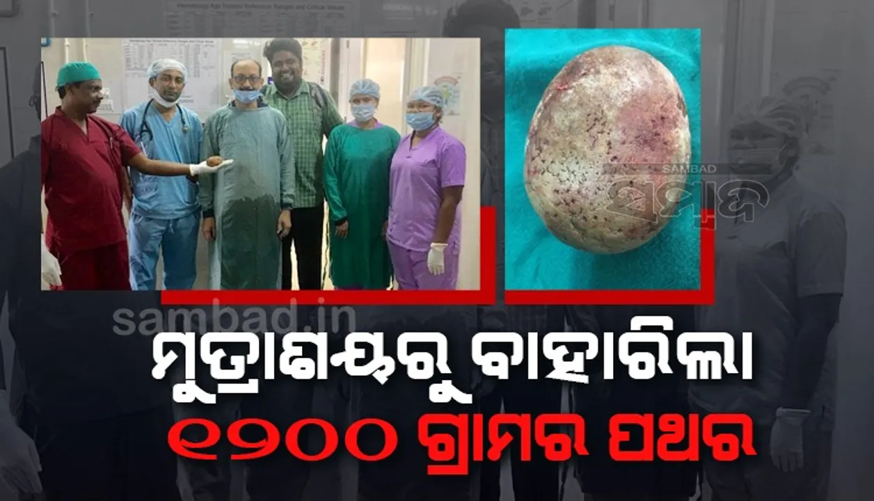  ଅସ୍ତ୍ରୋପଚାର ସମୟରେ ମୂତ୍ରାଶୟରୁ ମିଳିଲା ୧୨୦୦ ଗ୍ରାମର ପଥର