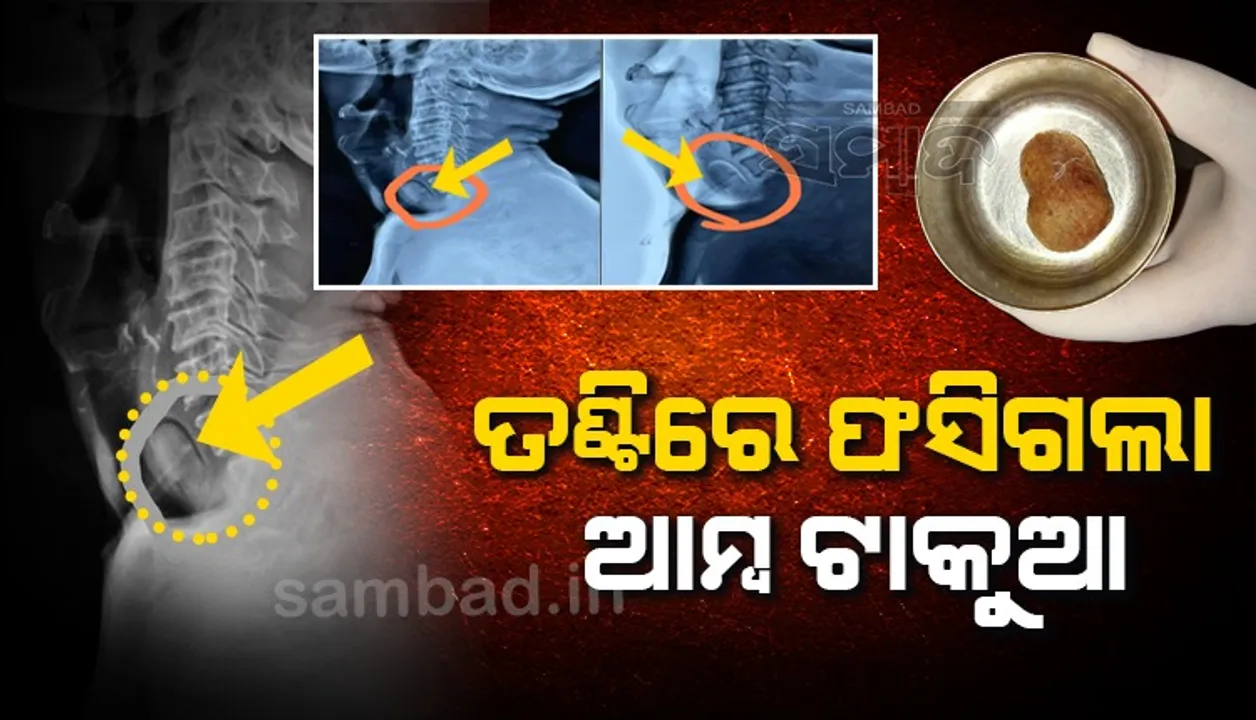  ପଖାଳ ଖାଉ ଖାଉ ତଣ୍ଟିରେ ଫସିଲା ଆମ୍ବ ଟାକୁଆ, ଡାକ୍ତରଙ୍କ ଉଦ୍ୟମ ଯୋଗୁଁ ବଞ୍ଚିଗଲା ଜୀବନ