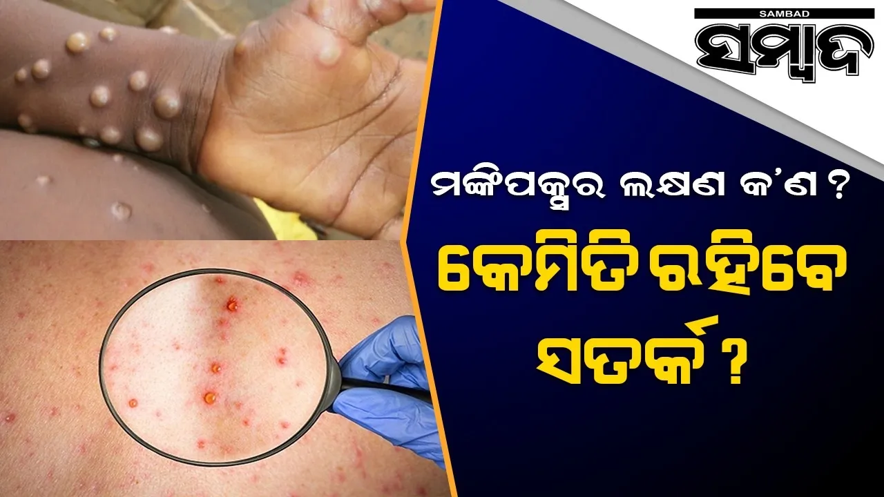  ଜାଣନ୍ତୁ ମଙ୍କିପକ୍ସର ଲକ୍ଷଣ କ’ଣ ଓ ଏଥିରୁ କିପରି ରକ୍ଷା ପାଇବେ ?