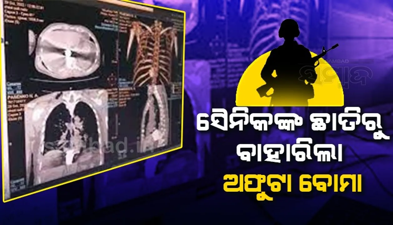  ଋଷ ଓ ୟୁକ୍ରେନ ଯୁଦ୍ଧରେ ଆହତ ହୋଇଥିବା ସୈନିକଙ୍କ ଛାତିରୁ ଅଫୁଟା ବୋମାକୁ ବାହାର କଲେ ଡାକ୍ତର