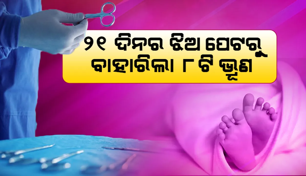  ୨୧ ଦିନର ଶିଶୁ ପେଟରେ ୮ଟି ଅବିକଶିତ ଭ୍ରୂଣ