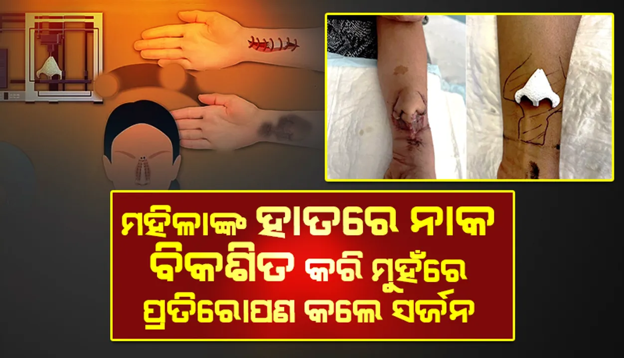  ମହିଳାଙ୍କ ହାତରେ ନାକ ବିକଶିତ କରି ମୁହଁରେ ପ୍ରତିରୋପଣ କଲେ ଫ୍ରାନ୍‌ସର୍‌ ସର୍ଜନ୍‌