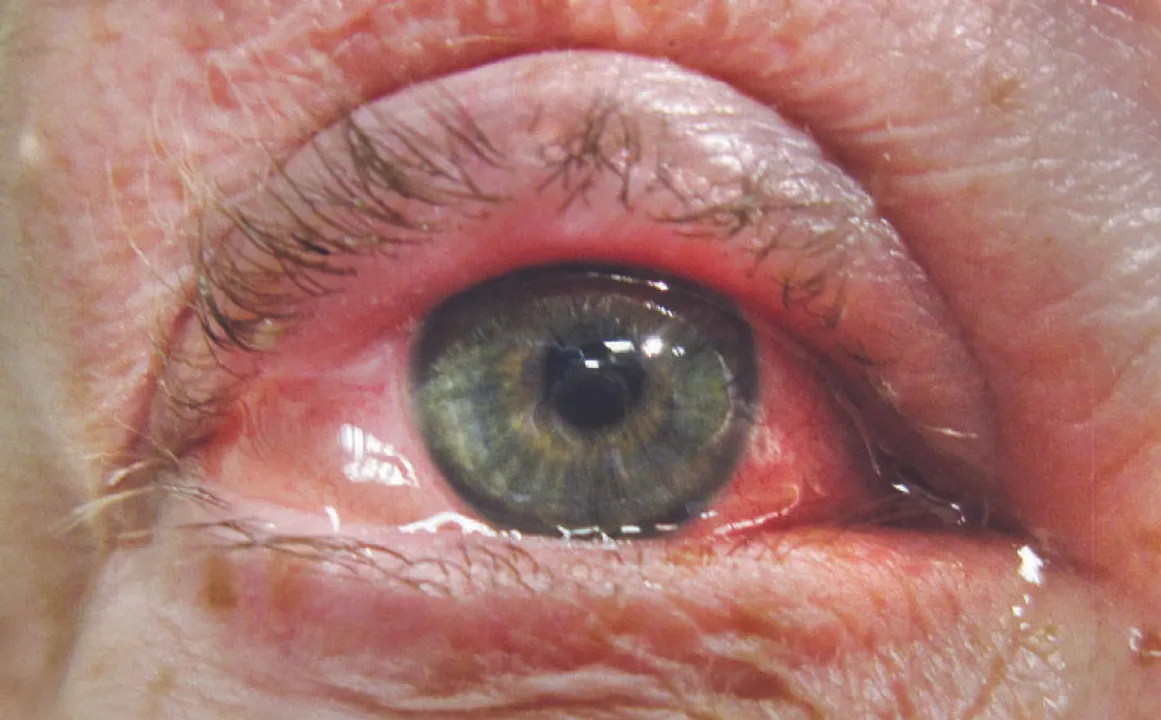  ମାଡ଼ୁଛି ଆଖିଧରା ରୋଗ; ଚଳିତମାସ ଗୁରୁତ୍ବପୂର୍ଣ୍ଣ