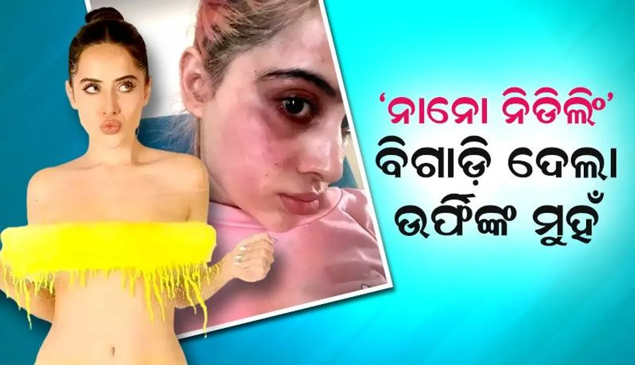  ନାଲି ପଡ଼ି ଫୁଲି ଯାଇଥିବା ମୁହଁର ଫଟୋ ସେୟାର୍‌ କଲେ ଉର୍ଫି ଜାଭେଦ; ଫିଲର୍ସ ପରେ ଏବେ ଚେହେରା ବିଗାଡ଼ିଲା ‘ନାନୋ ନିଡଲିଂ’