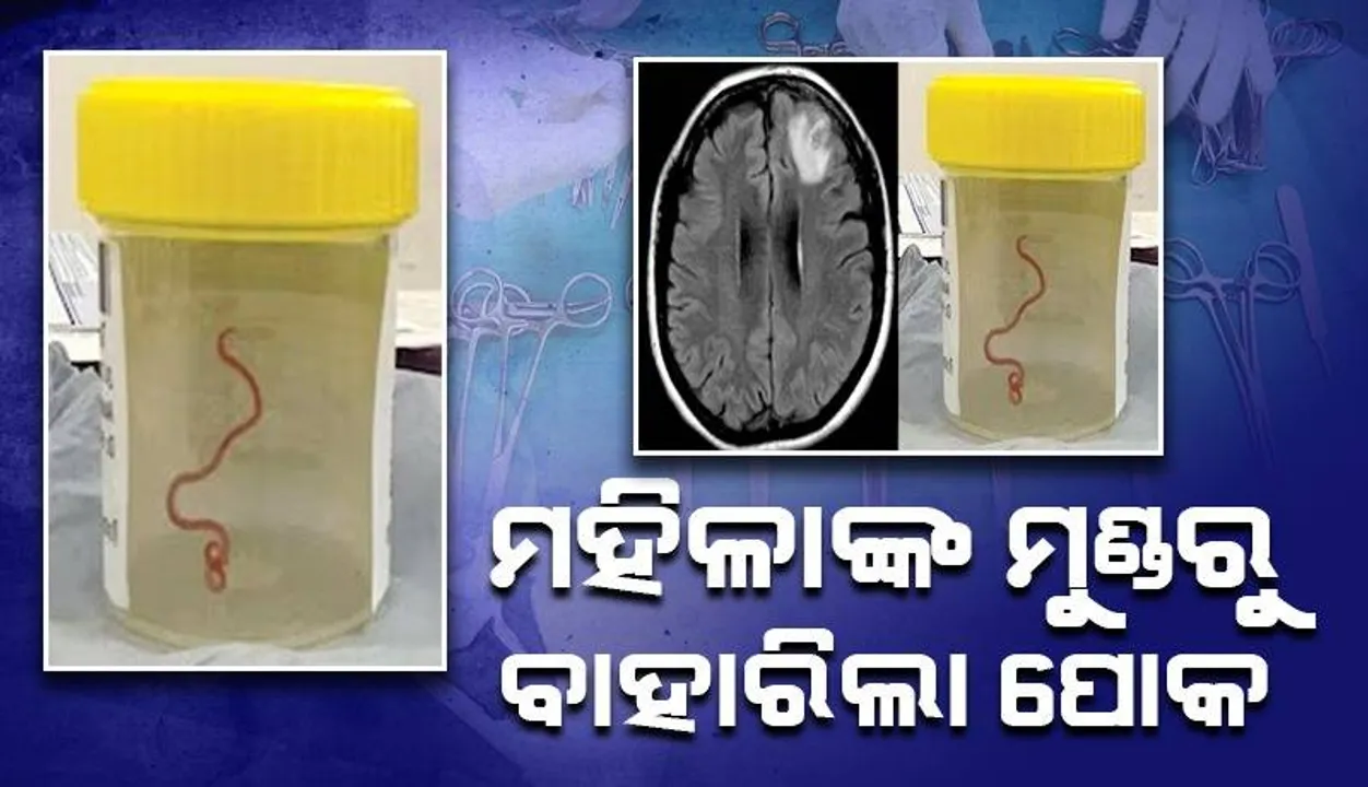  ବୃଦ୍ଧାଙ୍କ ମସ୍ତିଷ୍କରୁ ବାହାରିଲା ଏଭଳି ପୋକ, ଡାକ୍ତର ହେଲେ ଆଶ୍ଚର୍ଯ୍ୟ