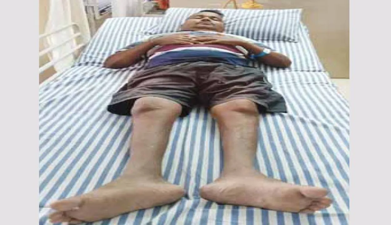  ପ୍ରଭୁକୃପାକୁ ଅନାଇ ବସିଛନ୍ତି ପ୍ରଭୁପ୍ରକାଶ: କିଡ୍‌ନି ପ୍ରତିରୋପଣ ପାଇଁ ଅର୍ଥ ବାଧକ