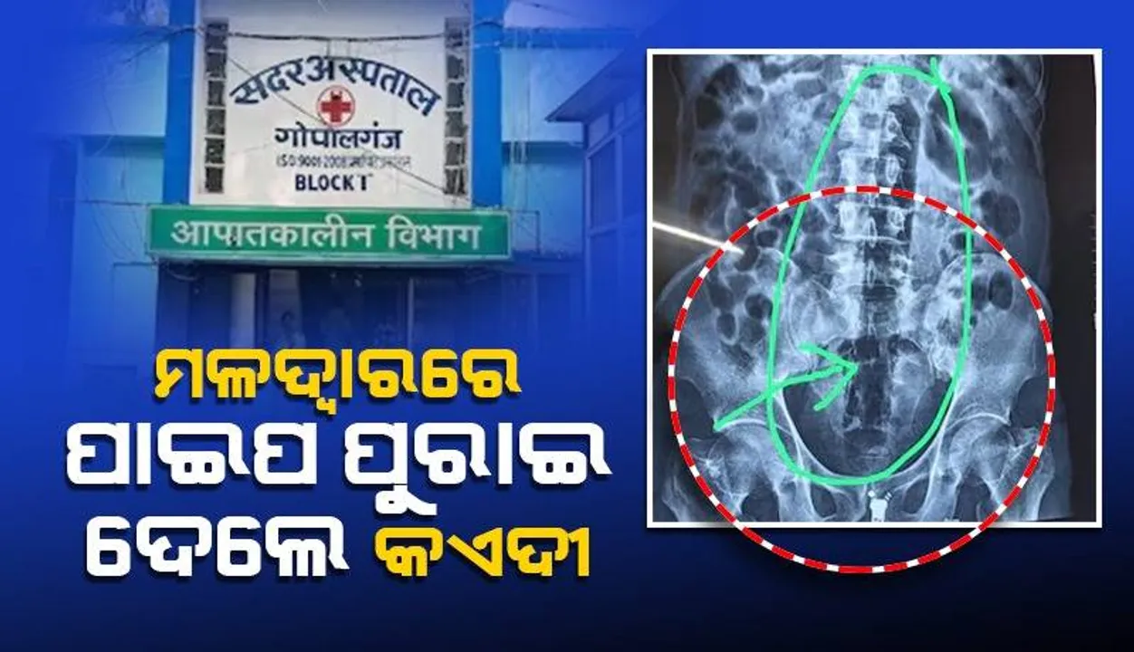  ଜେଲରେ ଥିବା ବିଚାରଧୀନ କଏଦୀ ମଳଦ୍ବାରରେ ପୁରାଇ ଦେଲା ପାଇପ