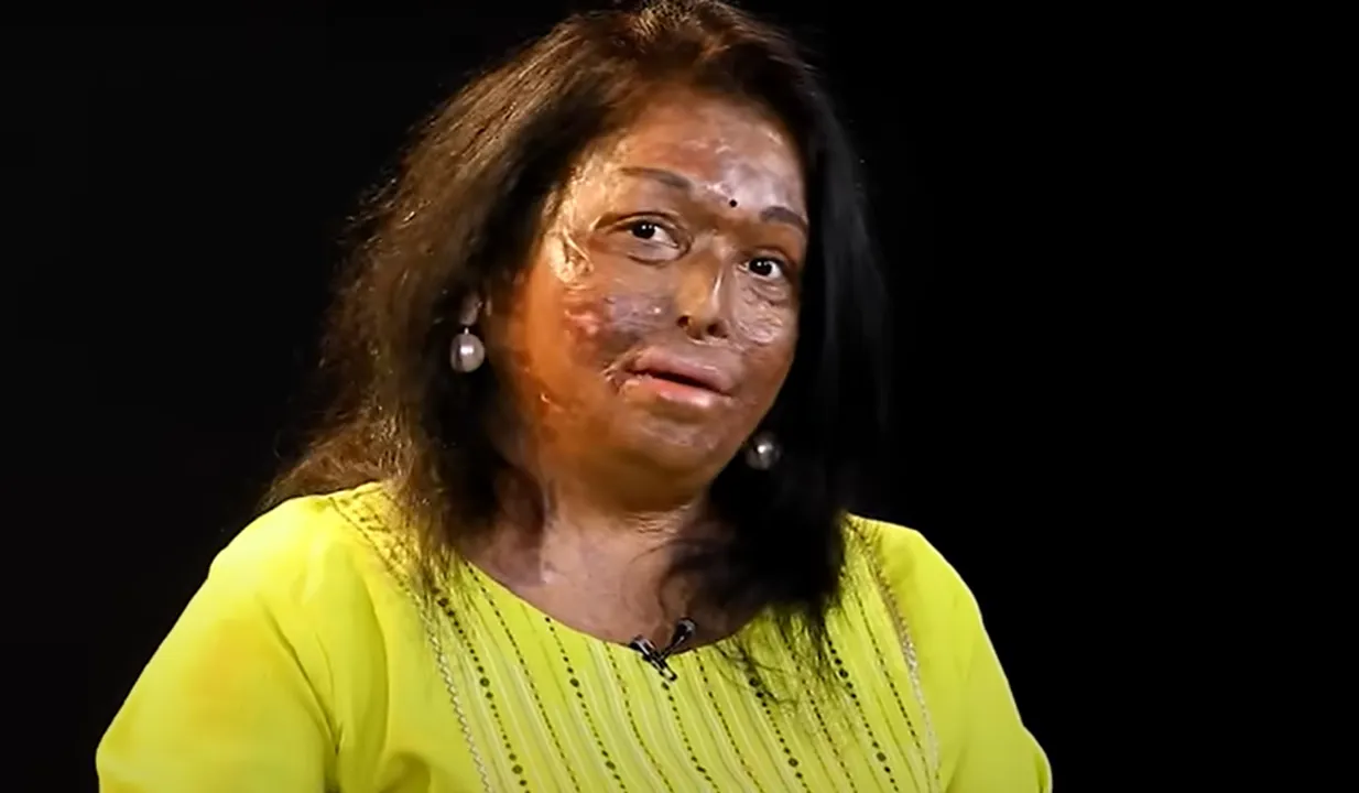 Sneha Jawle Burns Survivor