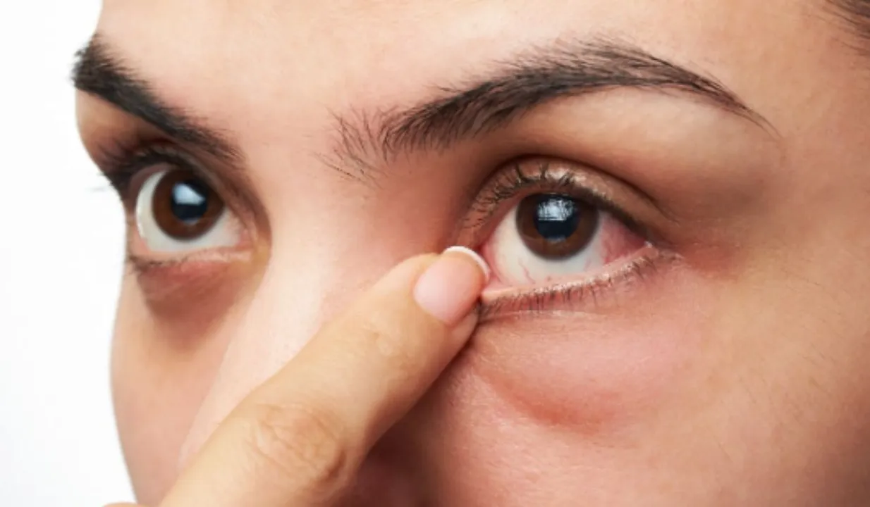 Eye Dryness World Sight Day