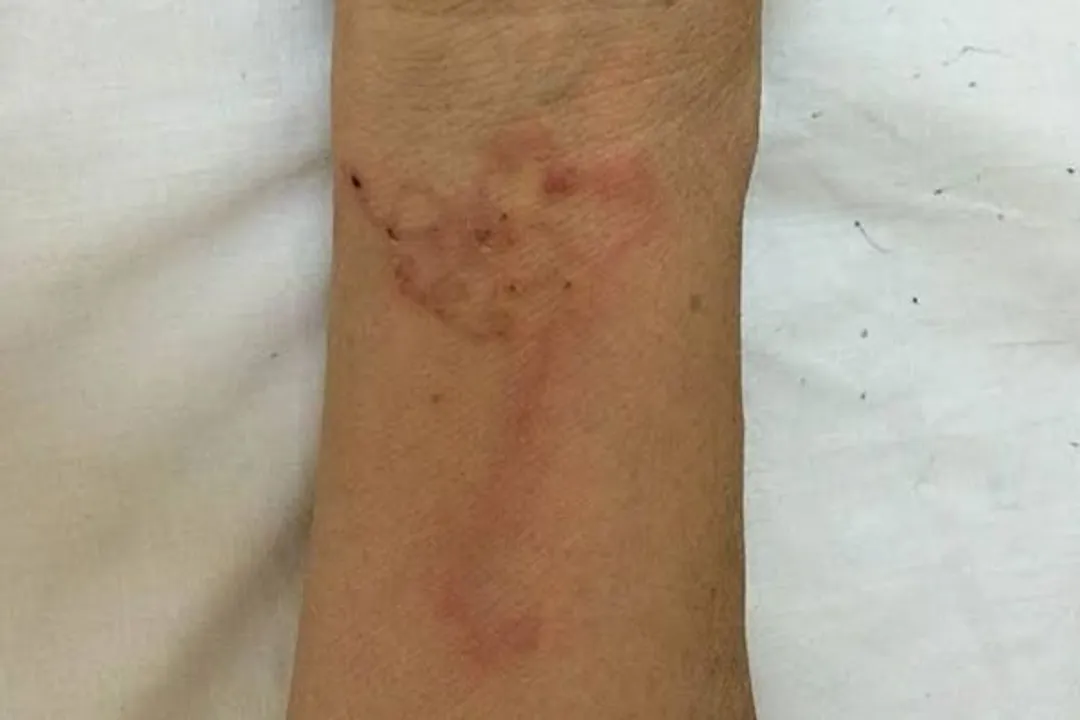 vietnamese woman gets worms in her skin