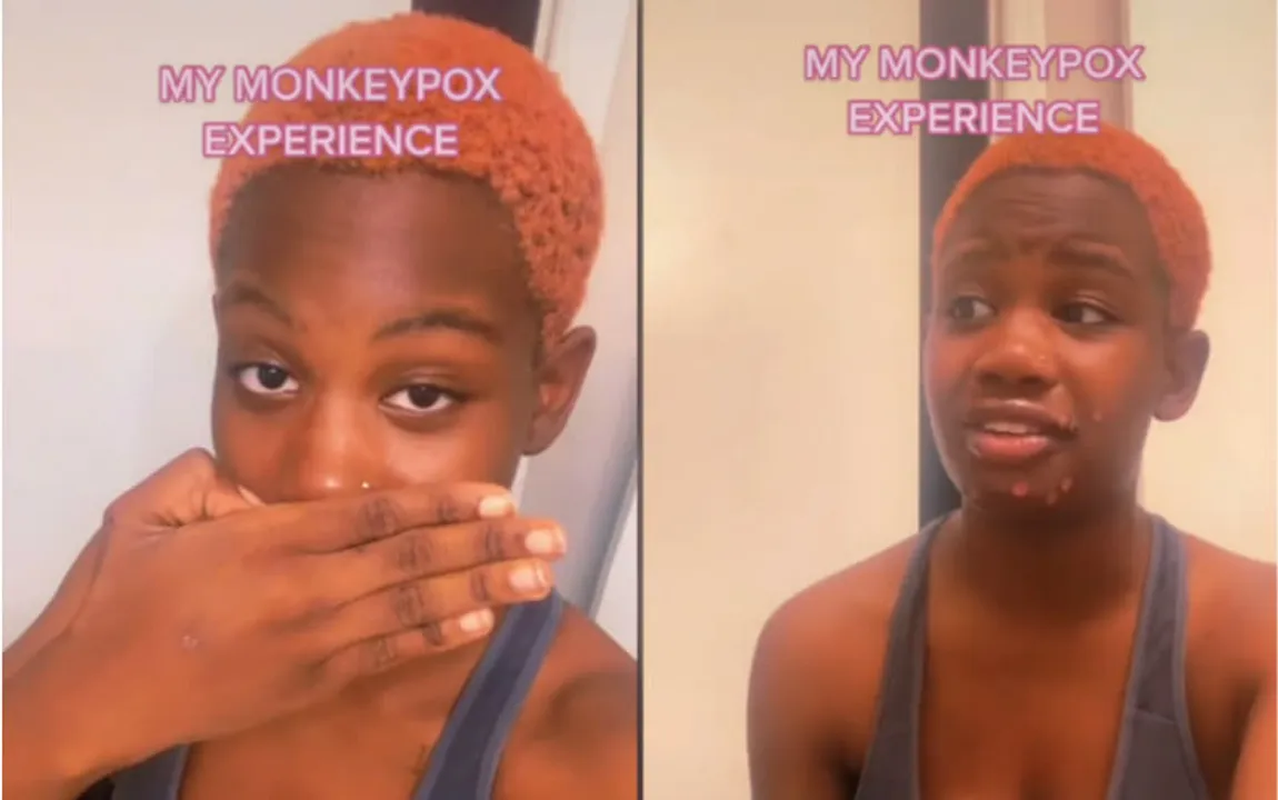 monkeypox misinformation