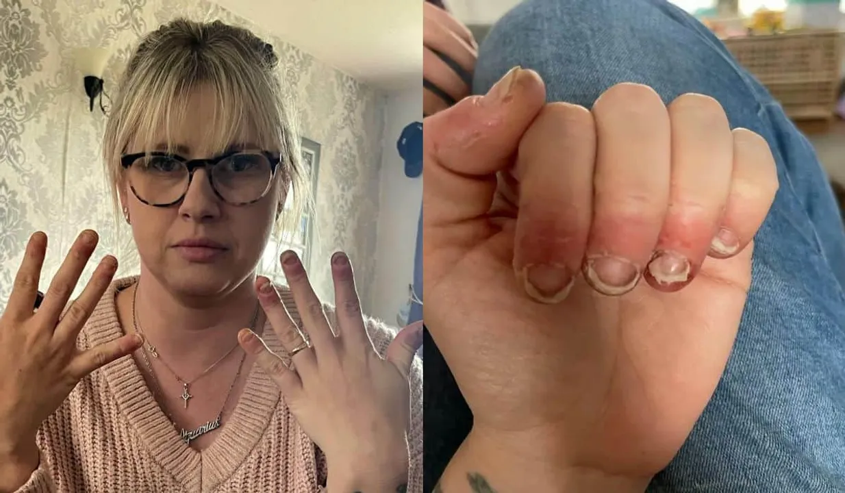 Woman Gets Allergy From Gel Nail Paint