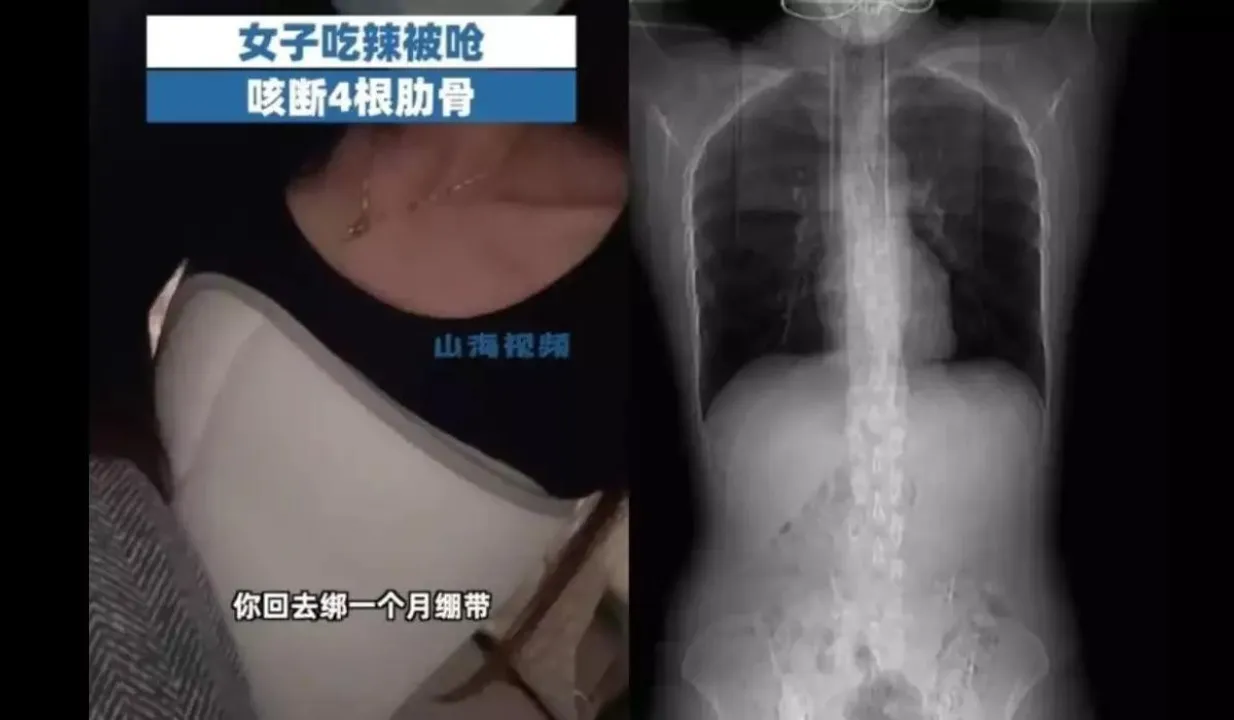 Woman Fractures 4 Ribs While Coughing After Eating Spicy Food