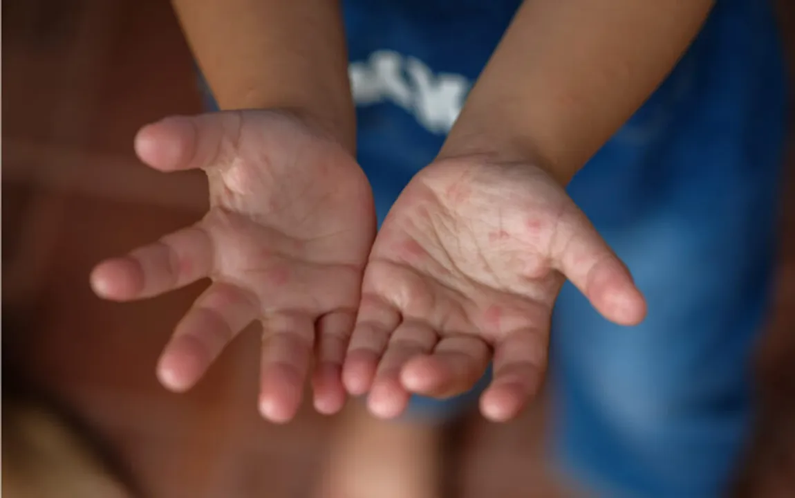 hand foot and mouth disease