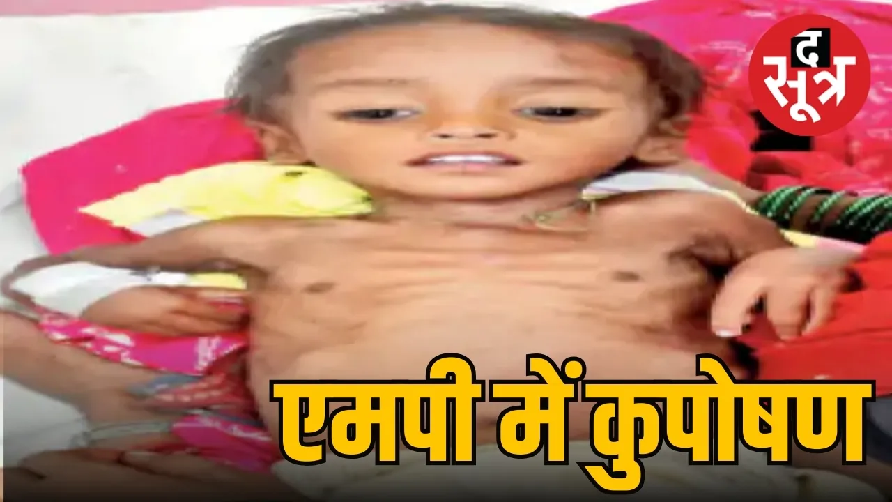 एमपी में कुपोषण