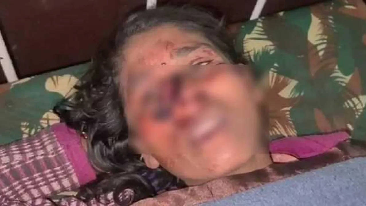 खंडवा: शराब के लिए पैसे न मिलने पर प्रेमी ने किया हमला, कुल्हाड़ी से प्रेमिका की नाक काटी