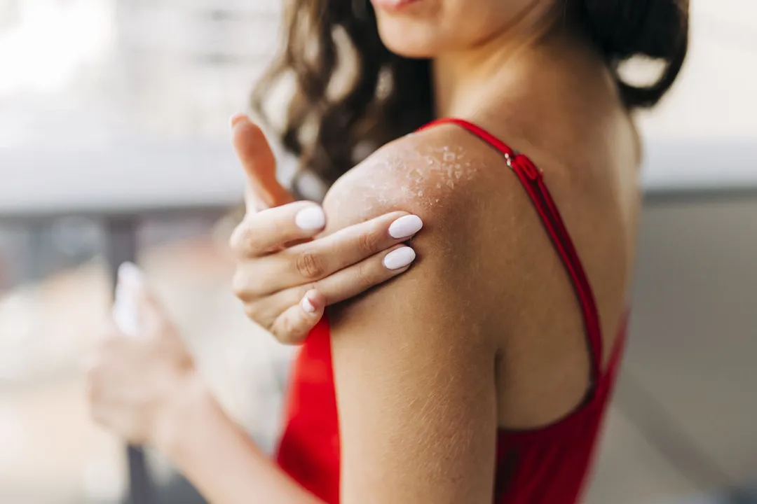 Dry skin