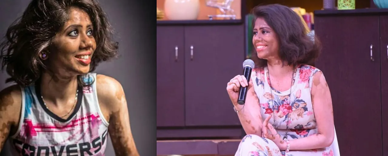 vitiligo model ramya