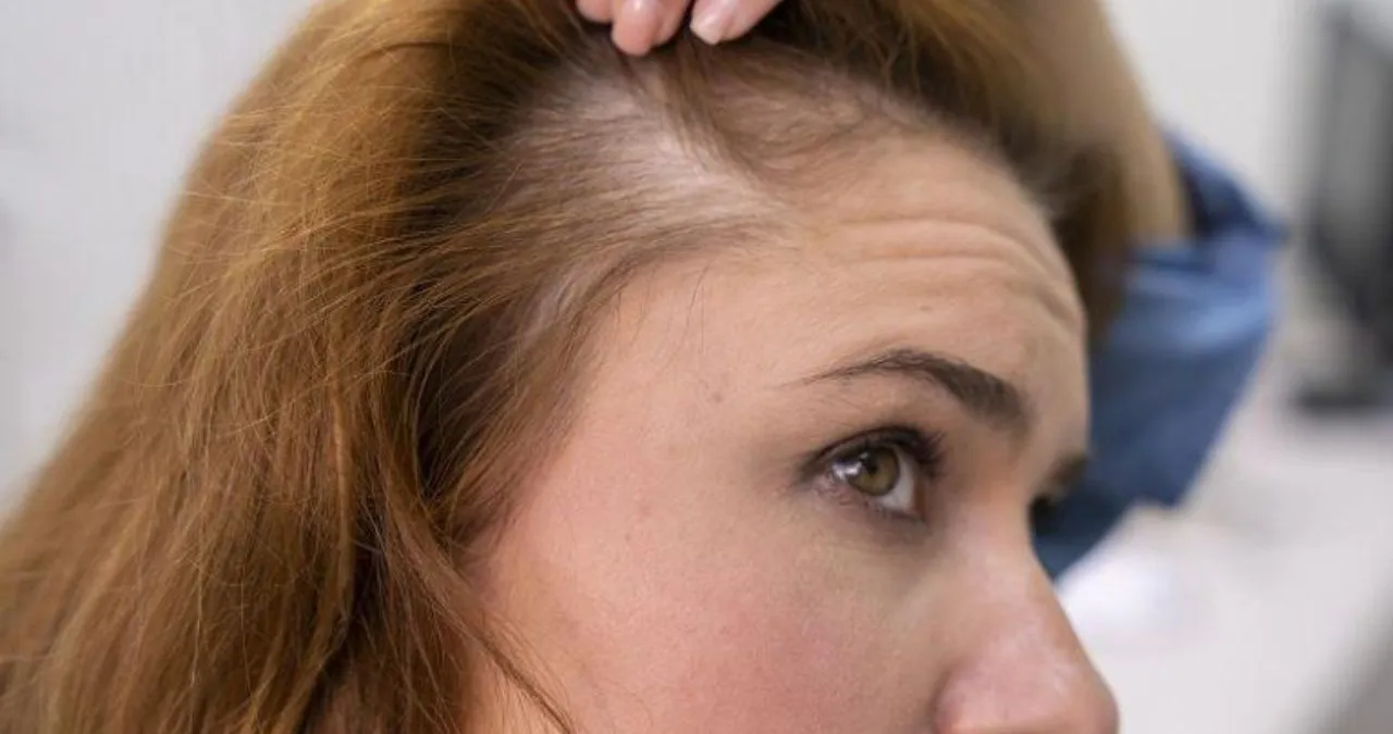 women baldness.jpg