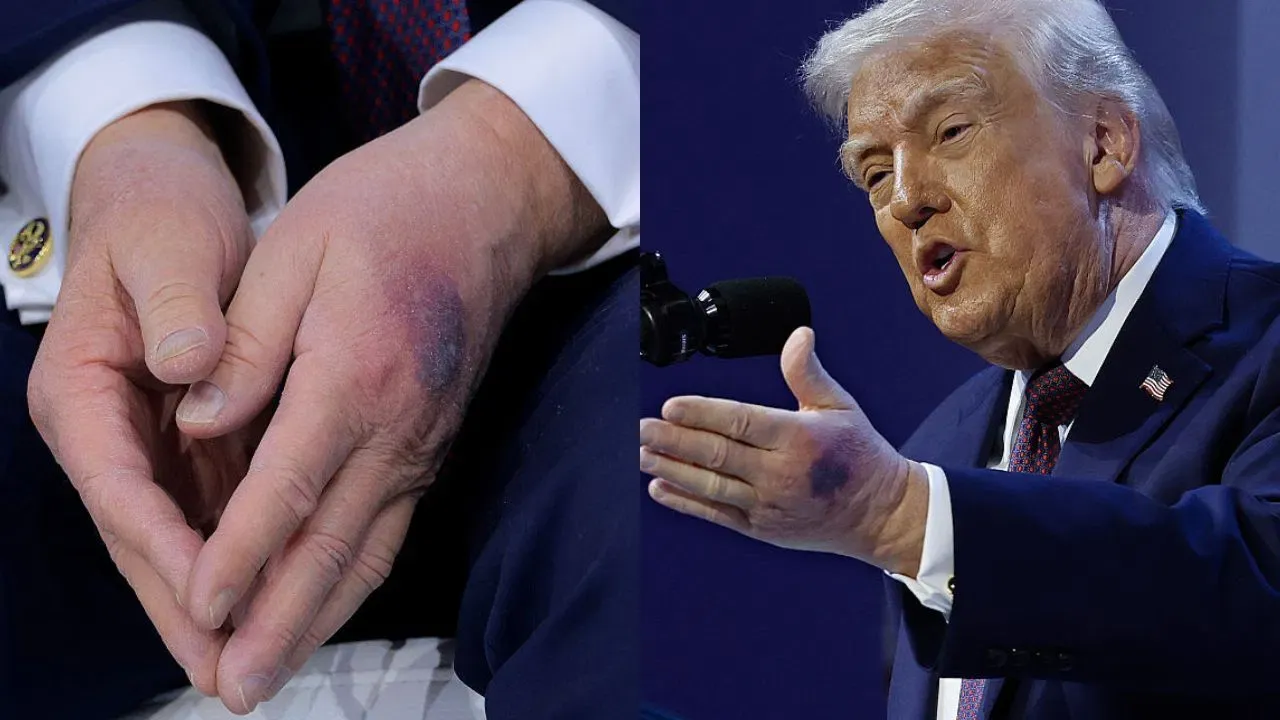  ट्रंप के हाथों पर चोट के निशान को लेकर अटकलें तेज, व्हाइट हाउस का जवाब सामने आया Photograph: (google) 
